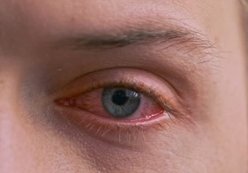 Close up of annoyed red blood blue eye of male affected by conjunctivitis or after flu, cold or allergy. Concept of health, disease and treatment. Irritated eye full with capillar net