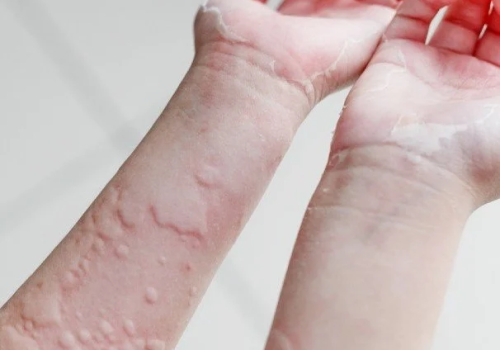 urticaria-amp_hero-1